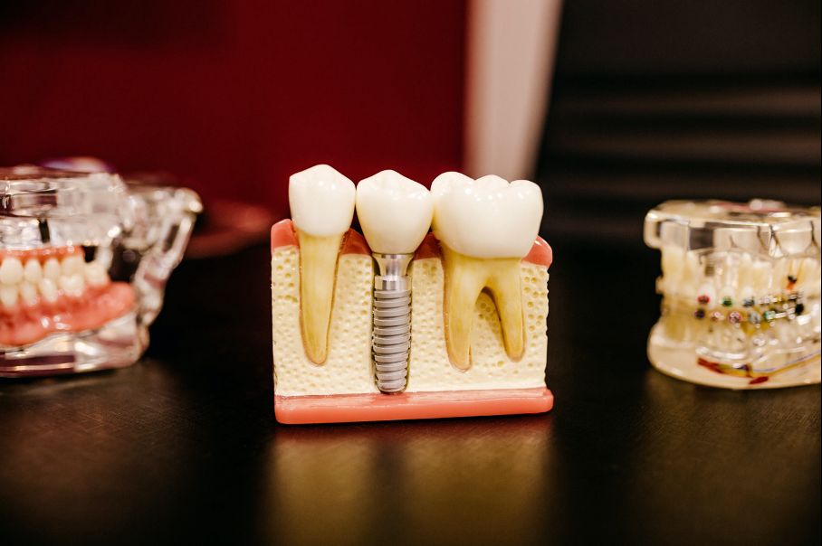 Dentalimplantat mit Keramikkrone