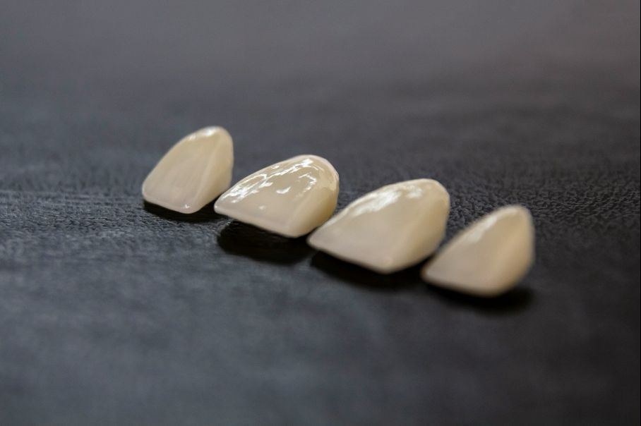 Strahlendes Lächeln mit Veneers